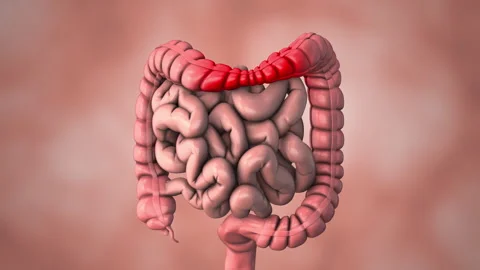 Inflammatory Bowel Disease Treatment